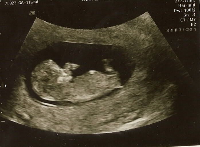 10 Weeks Pregnant Ultrasound Pictures