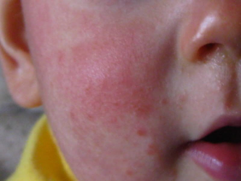 Toddler Red Bumps On Face - Doctor answers on HealthTap