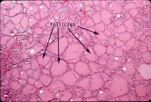 thyroid folliclese