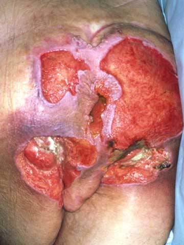 Decub Ulcer